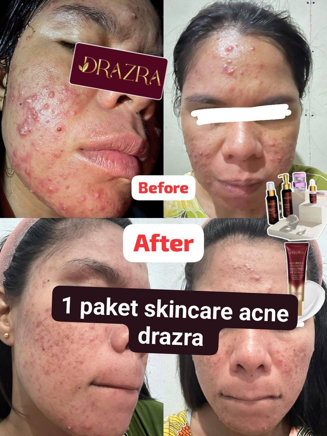 Testimoni before after satu paket skincare acne DRAZRA